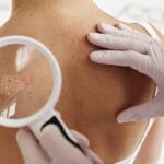 Hemofarm: Psorijaza je više od kože