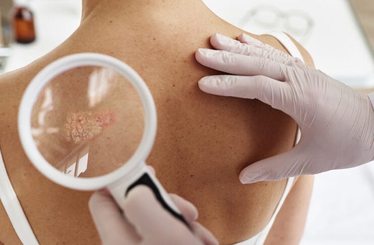 Hemofarm: Psorijaza je više od kože